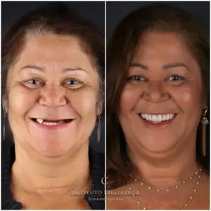 Paciente sorrindo após a colocação de implantes dentários no Instituto Lago Costa, com resultados naturais e duradouros."