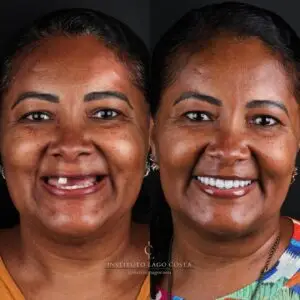 Paciente sorrindo após a colocação de implantes dentários no Instituto Lago Costa, com resultados naturais e duradouros."