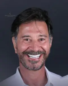 Aplicação de lentes de contato dental no Instituto Lago Costa, oferecendo tratamentos estéticos para um sorriso perfeito em Feira de Santana.