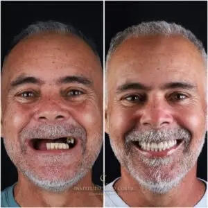 Paciente sorrindo após a colocação de implantes dentários no Instituto Lago Costa, com resultados naturais e duradouros."