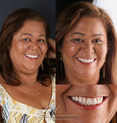Implantes Dentários