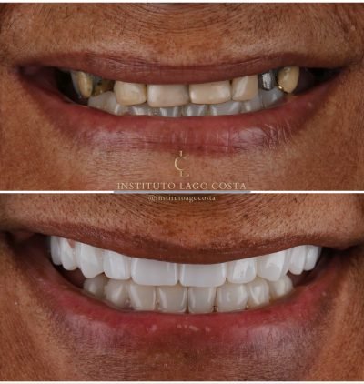 Implantes Dentários