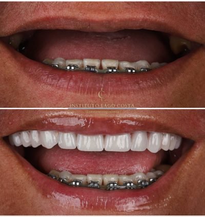 Implantes Dentários