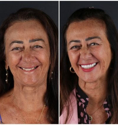 Implantes Dentários