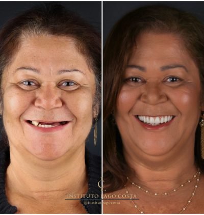 Implantes Dentários