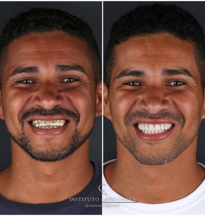 Implantes Dentários