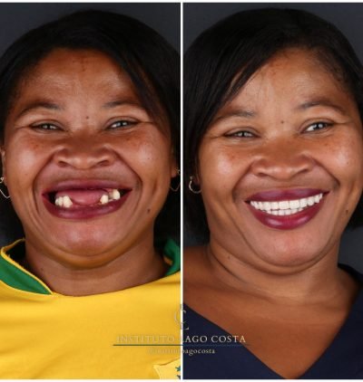 Implantes Dentários