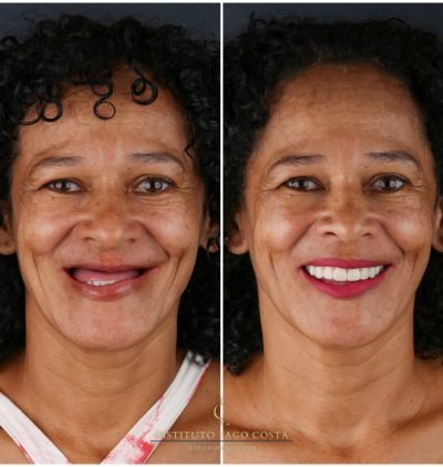 Implantes Dentários