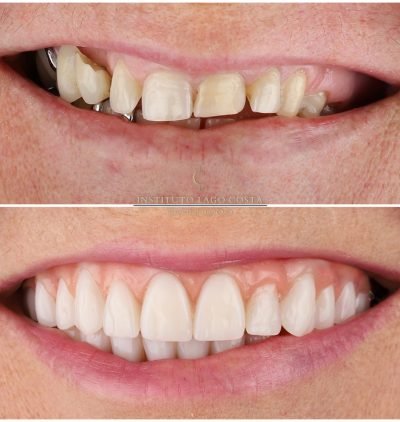 Implantes Dentários