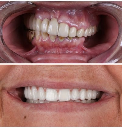 Implantes Dentários